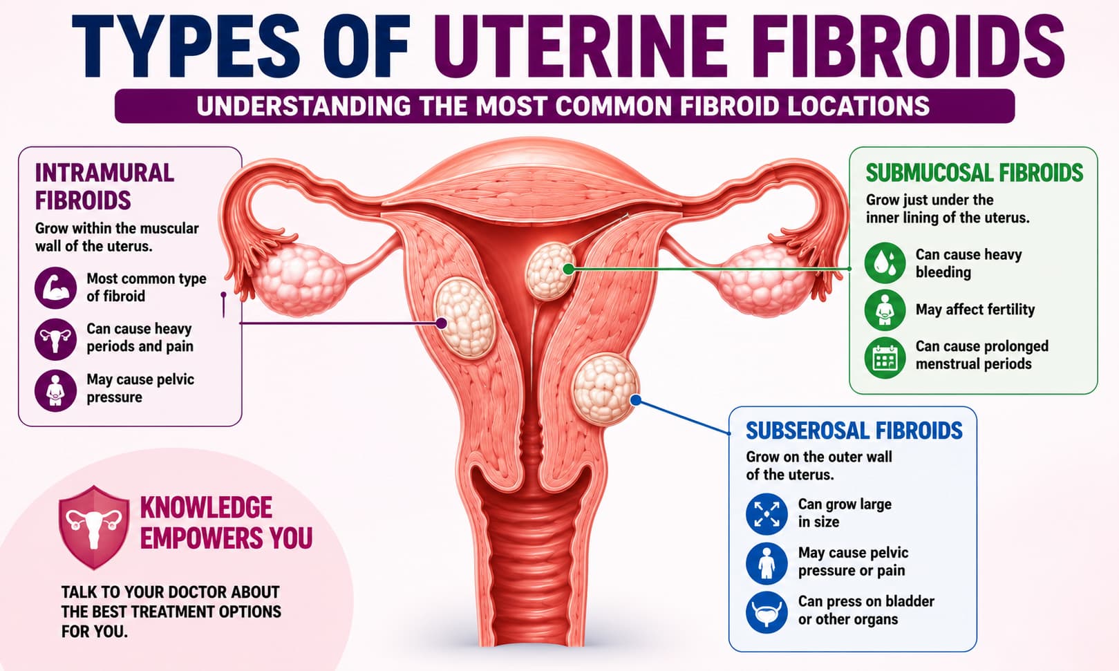 Medical illustration of the female reproductive system showing the uterus with labeled examples of intramural, submucosal, and subserosal fibroids.